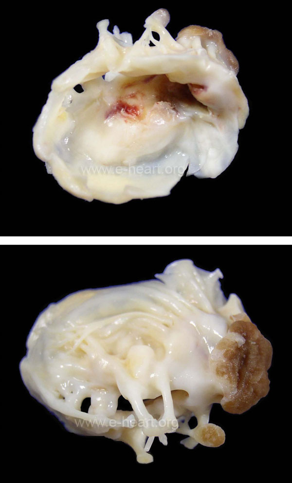 Rheumatic excised valve